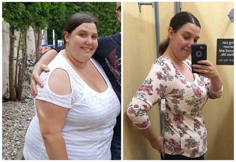 Gastric Bypass Surgery Pictures Before And After Gastric