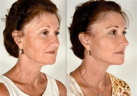 long   facelift  charleston facial plastic surgery