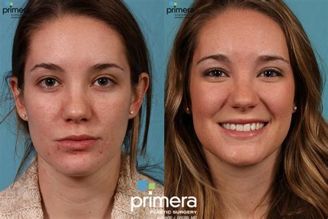 fraxel® laser treatment for orlando fl primera plastic