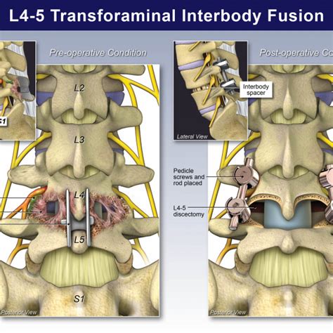 L4 5 Transforaminal Interbody Fusion Trialexhibits Inc