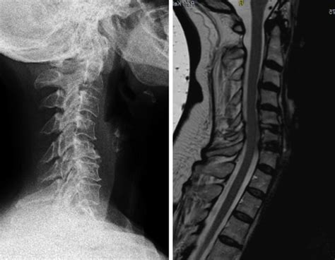 prof linhardt fallbeispiel fehlstellungen und spinalstenosen der hws