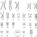 Syndrome Down Karyotype Trisomy 21 Types Chromosome Extra Scitable Science sketch template