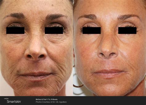 laser treatment wrinkles scars   medical