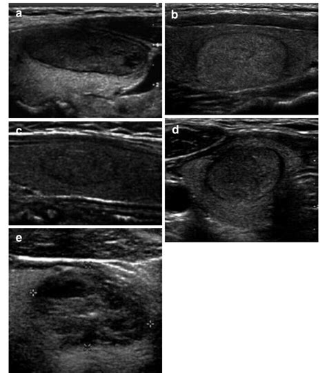 nodule echogenicity images  ultrasound exams performed