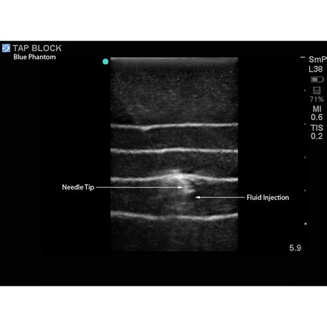 blue phantom tap block ultrasound training model tissue insert  blue phantom bpp
