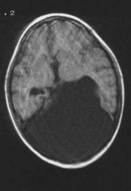 nijmegen breakage syndrome workup laboratory studies imaging studies histologic findings