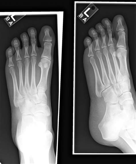 normal foot  buyxraysonline