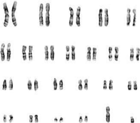 Figure1 46 Xy Karyotype In A Case With Female Phenotype Download