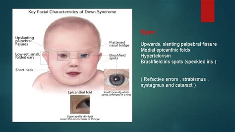 Palpebral Fissures Down Syndrome Quotes Trending