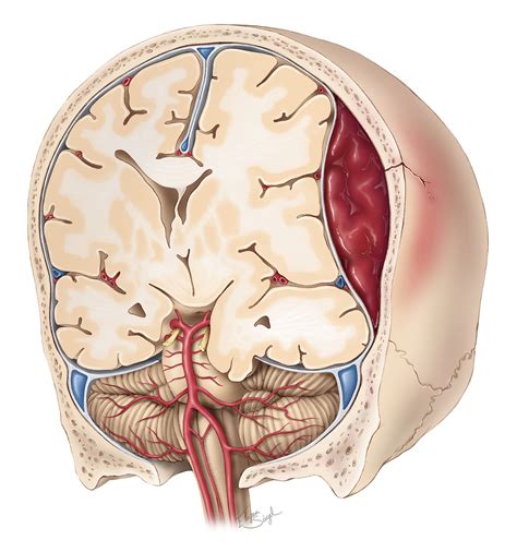 epidural hematoma  neurosurgical atlas