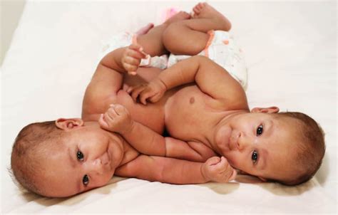 Qatar’s First Conjoined Twins Successfully Separated Marhaba Qatar