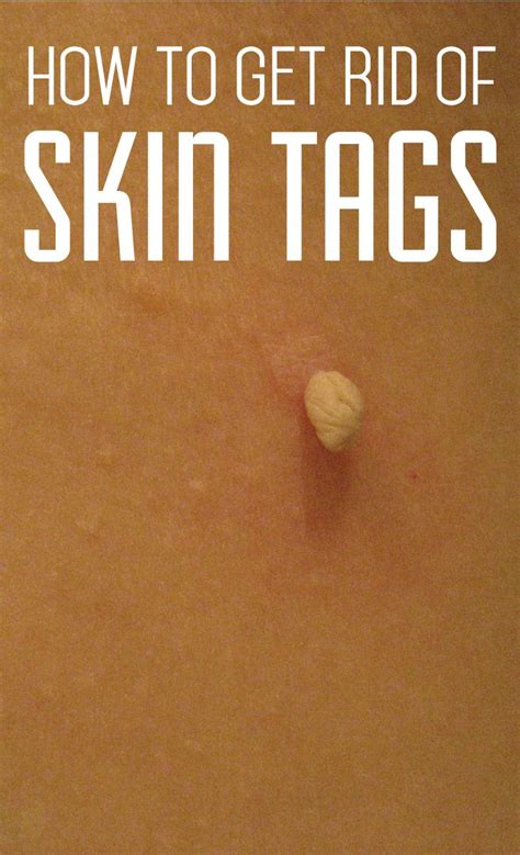 how to get rid of skin tags skin tags home remedies skin tag remove skin tags naturally