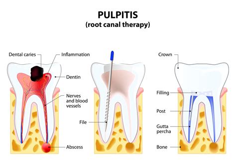 root canal therapy smile center villa rica