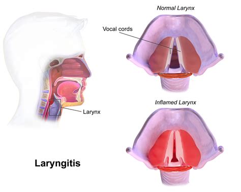 best ways on how to treat laryngitis health cautions