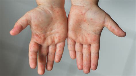 hand foot mouth disease symptoms discover  common hand foot