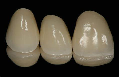 maxillary anterior  ceramic crowns fororg