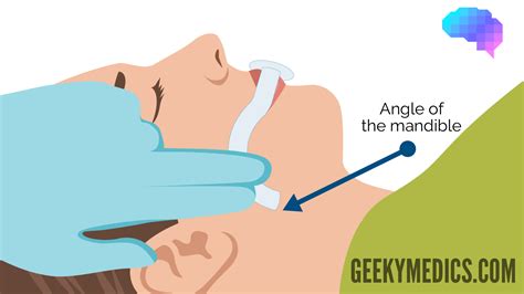 oropharyngeal airway guedel airway insertion osce guide geeky medics