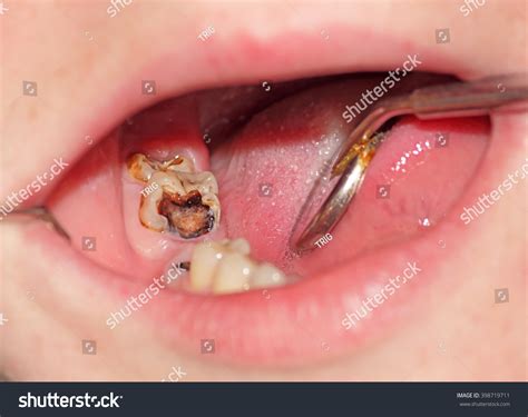 tooth decay   molar image close  stock photo