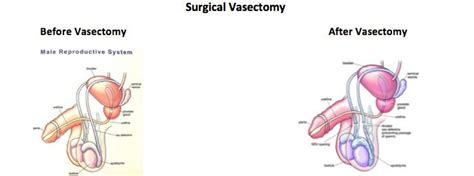 does insurance cover vasectomy ~ news word