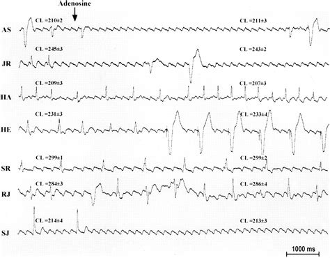 Relationship Between Atrial Fibrillation And Typical Atrial Flutter In