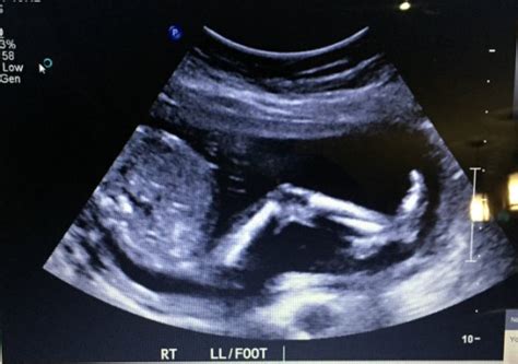 19 week ultrasound and tech didn t find gender update september 2015