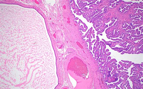 pathology outlines paratubal cysts
