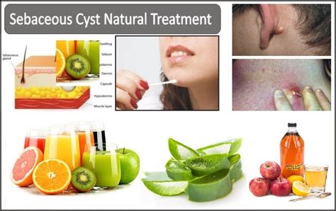 natural treatment of sebaceous cyst with home base ingredients herbs