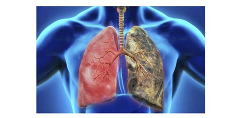 Epoc Enfermedad Pulmonar Obstructiva Crónica Síntomas