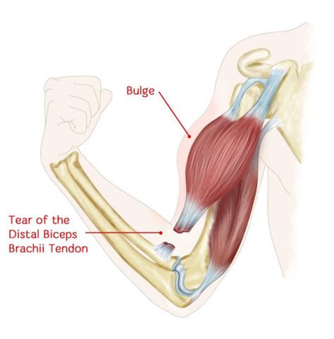 Distal Biceps Tendon Tear – Dr Edward Weldon