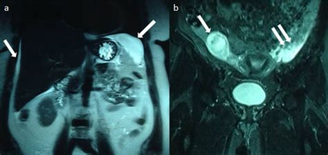 Pseudo Meigs Syndrome Associated With Struma Ovarii Bmj Case Reports