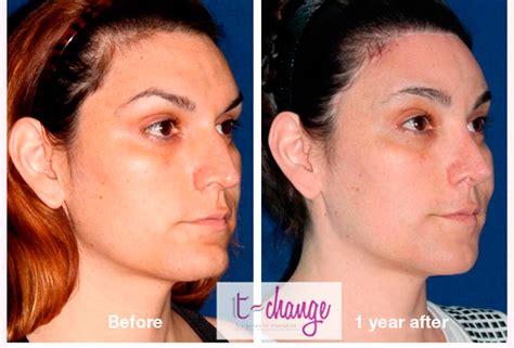 facial feminization before and after tiffany teen free prono