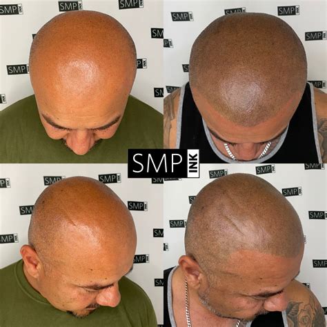 scalp micropigmentation     smp ink