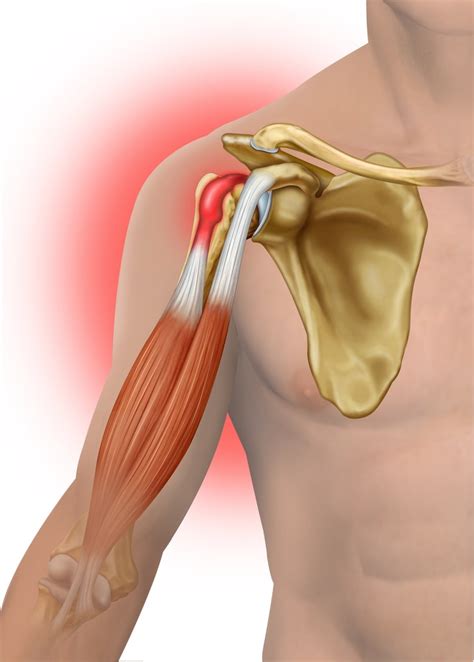 biceps tendinitis   risk factors