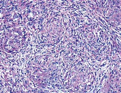 Pathology Outlines Sarcoidosis