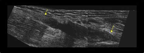 Musculoskeletal Joints And Tendons 6 2 Elbow Case 6 2 8 Distal