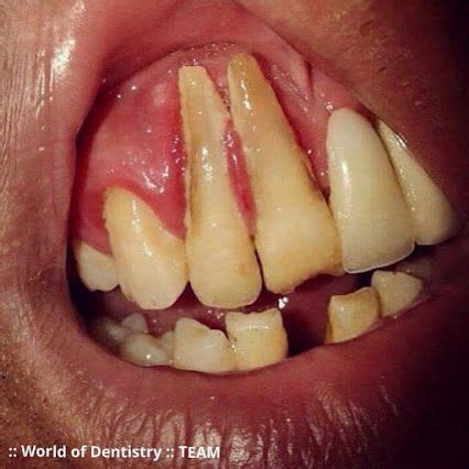 gingival recession receding gums refers   progressive loss  gum tissue dental health