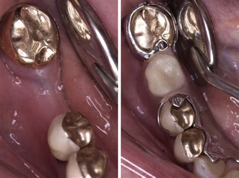 gold crowns pocket dentistry