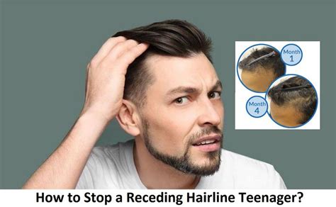 stop  receding hairline teenager complete expert guide
