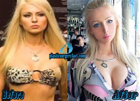 Barbie Woman Plastic Surgery Before And After Photos
