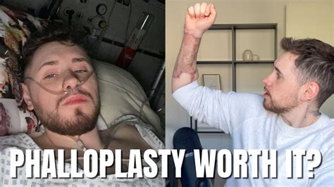 My Ftm Phalloplasty Story 3 Months Later And The Complications I Ve