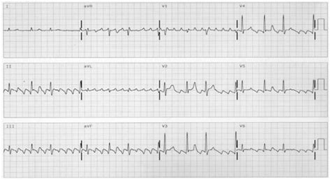 Atrial Flutter Common And Main Atypical Forms