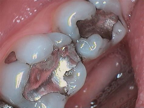 amalgam removal  composite fillings mg dentistry