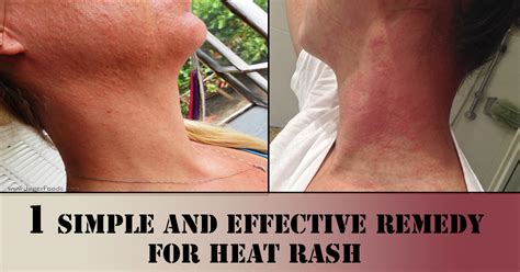 home remedy for heat rash treatment