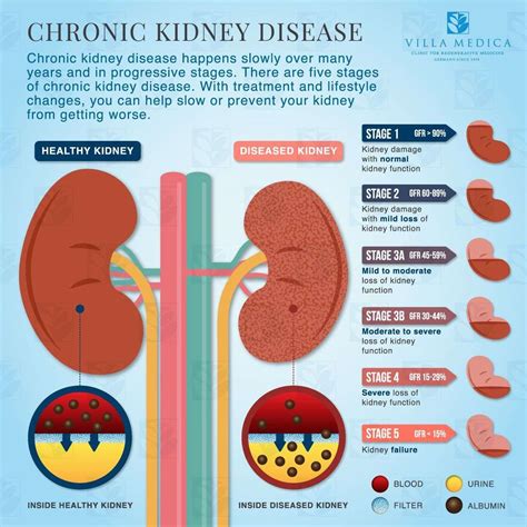 stages  kidney failure healthykidneyclubcom