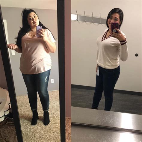 Gastric Bypass Before And After Pictures Skin The Most