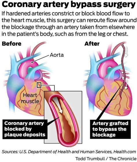 heart bypass deaths fall  care reporting improve sfgate