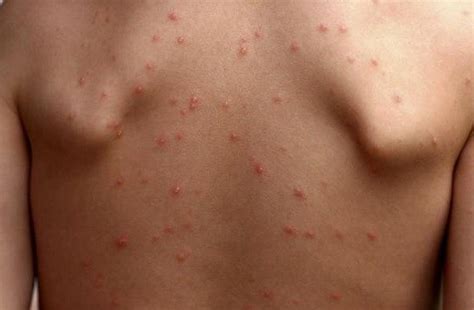 One Of Hiv Symptoms Is Rash A Very Important Article To