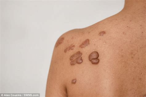 nhs won t treat woman s unsightly scars because they re