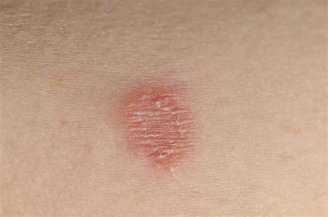rash on buttocks herpes pictures answers on healthtap