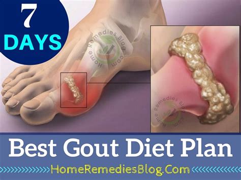days  purine gout diet plan prevention